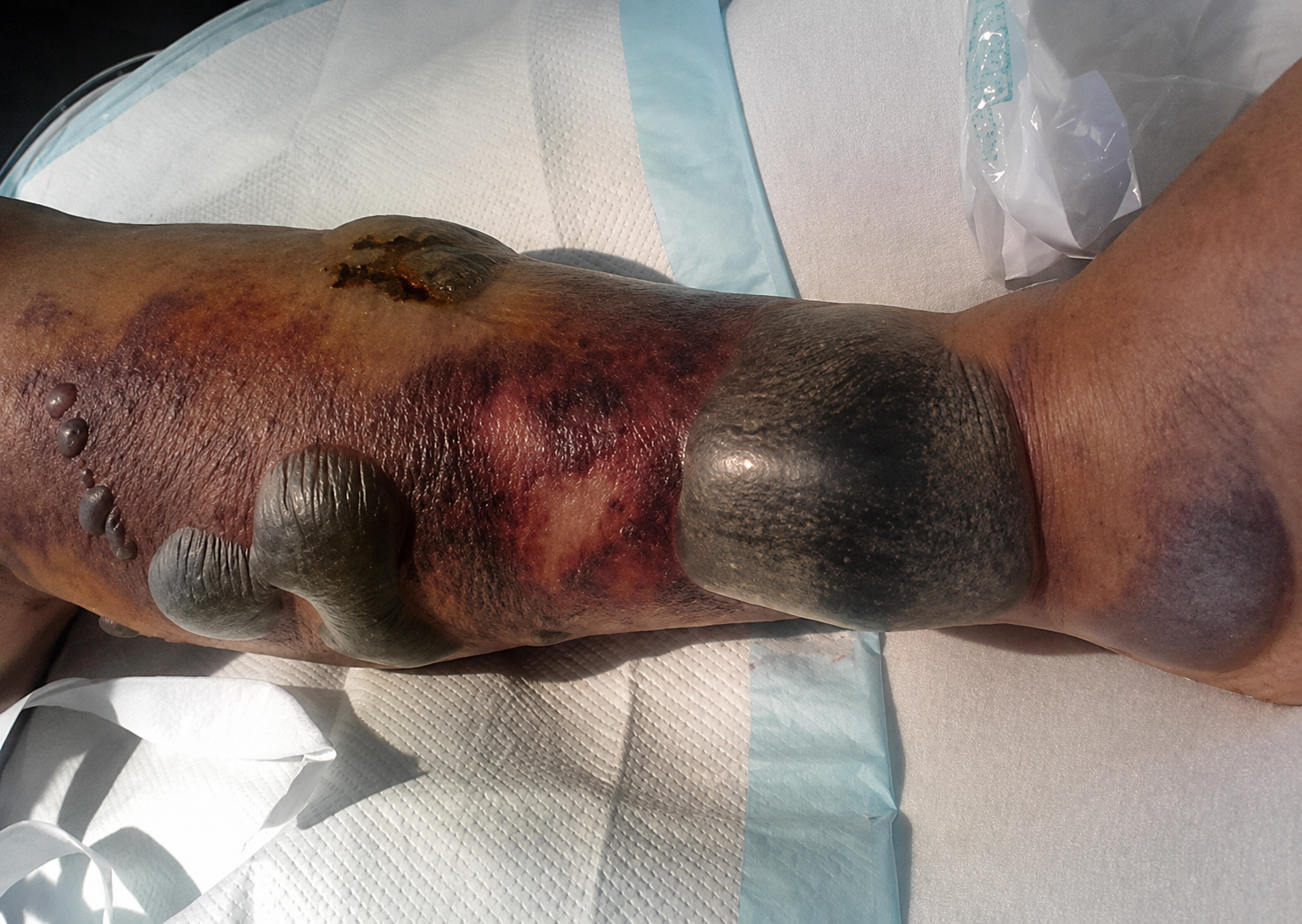 Stage 3 — late: haemorrhagic bullae, necrosis and crepitus